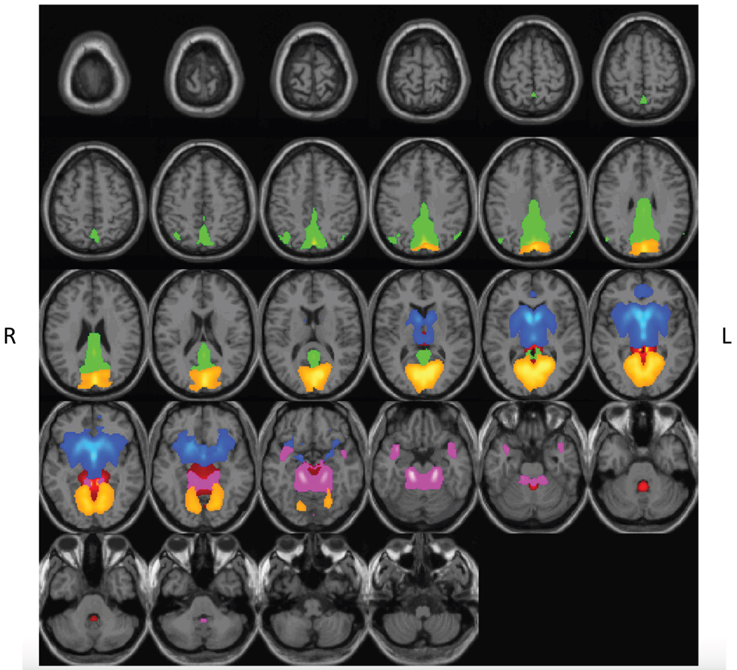Spatial rendering of brain networks that display reductions in intrinsic connectivity during Δ9-tetrahydrocannabinol (THC) intoxication. Spatial rendering of functional networks where THC (vs. placebo) reduced intrinsic functional connectivity (0.05 < Hz < 0.12). Networks included subcortical domain–extended hippocampal subdomain (red), subcortical domain–basal ganglia subdomain (blue), triple network–default mode (green), paralimbic (pink), and visual domain–occipitotemporal subdomain (orange). Spatial components are thresholded (t > 2.0). L, left; R, right.