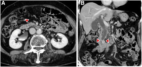 Dynamic CT images, arterial phase, a axial view, and b coronal view show thickening of the wall that is enhanced in the lower part of the CBD (red arrowheads), accompanied by a proximal dilatation of the biliary tract. No lymph node metastases are observed