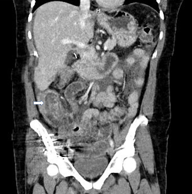 Computed tomography (CT) scan (coronal with arrow) of abdomen showing terminal ileum intussusception into the colon.