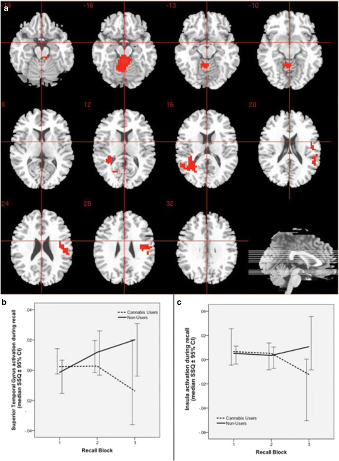Change in brain activation during repeated recall. a Group difference activation map. b Median activation of cannabis users and non-users in the left superior temporal gyrus, extending to the middle temporal gyrus and caudate. c Median activation of cannabis users and non-users in the right insula extending to the superior temporal gyrus. Right side of the brain is represented in the right side of the images