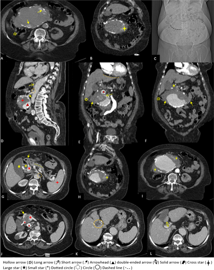 A, B non-contrast axial and coronal computed tomography scan show a huge hetero-dense mass in the sub-hepatic region, near to the head of the pancreas and medial to the cecum (yellow hollow arrow), with focal bulging at its medial margin (yellow cross star) and peripheral calcification and marginal hyper-dense crescent-like foci (short yellow arrows) suggestive of probably an aneurysm with hyperdense crescent sign. C Abdominal computed tomography scan Topogram: curvilinear calcification is visible mainly at right side of thoracolumbar spine in the sub-hepatic region. D Sagittal plane of computed tomography angiography, reveals an aneurysm with mural thrombosis (red cross star) and its patent lumen (red arrowhead) originating from the posterior and inferior surface of the proximal of the superior mesenteric artery (short arrow). The origin of the celiac trunk (dotted circle) is significantly narrowed due to the compressive effect of thickened diaphragmatic crura (long arrow). E, F Coronal plane of computed tomography angiography shows considerable compressive effect of huge aneurysm on the cecum, D2 and D3 portions of the duodenum (short yellow arrows) and common bile duct (small yellow star). A thrombus fissuration sign (long yellow arrow) is an extension of contrast from the patent lumen to the mural thrombus. The red arrowhead points to the another aneurysm, located at the superior margin of the giant aneurysm. The orange dashed line shows the slightly irregular liver’s margin. G Portal vein (small red star) and dilated common bile duct and are visible on the axial plane in the porta-hepatis region. The gallbladder is shown by the large star. The pylorus and D1 portion of the duodenum are indicated by the small yellow arrow. A yellow dashed line represents mild dilatation of the main pancreatic duct. The celiac trunk's origin has narrowed significantly (dotted circle). The red cross star represents the spleen. H, I The yellow cross stars indicate focal bulging and discontinuous calcification at the medial and lateral margins of the huge aneurysm. Mild fat stranding is present, adjacent to medial margin of the aneurysm. J The axial scan just inferior to "G". Gastroduodenal artery (GDA) is shown by short yellow arrow. Two aneurysms originating from the posterior branch of GDA (posterior superior pancreaticoduodenal artery) are depicted by the red arrowheads. (K, L) The central intrahepatic bile ducts are mildly dilated. The anterior periportal space is widened