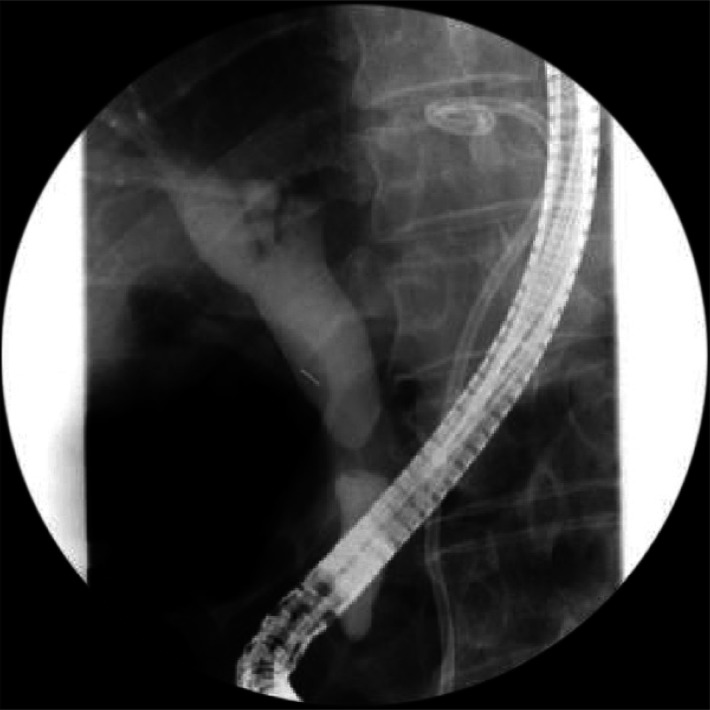 Endoscopic retrograde cholangiopancreatography shows concentric narrowing at the mid-common bile duct (CBD) with tapering of both proximal and distal CBD.