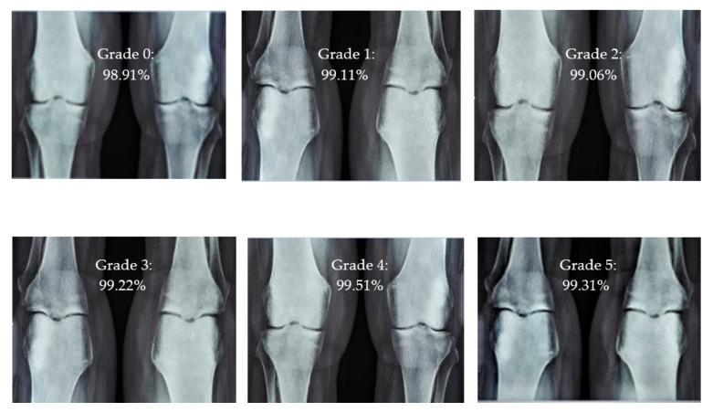 Different CBD grade levels of knee rheumatoid arthritis.