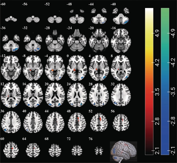 ReHo changes in patients with ASD. Brain regions showing significant differences were the bilateral middle occipital gyrus, right cerebellum crus I and II, supplementary motor area, left angular gyrus, thalamus, parahippocampal gyrus, and hippocampus (GRF‐corrected, p voxel < 0.001, p cluster < 0.05, adjusted for age, sex, and head coil). The colorbars represent the t‐values: Positive values indicate higher ReHo values in patients with ASD than in TDCs (patients>controls), while negative values indicate the opposite (patients<controls).