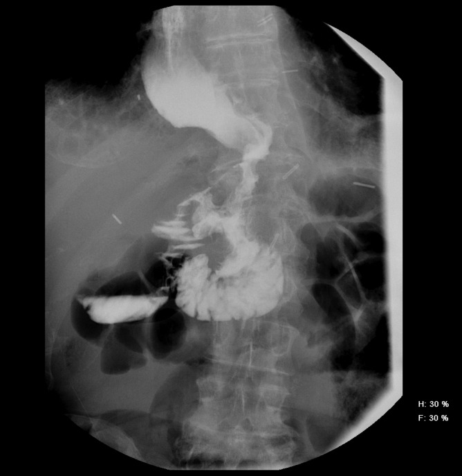 Post-stent removal UGI series showing no leak or obstruction.