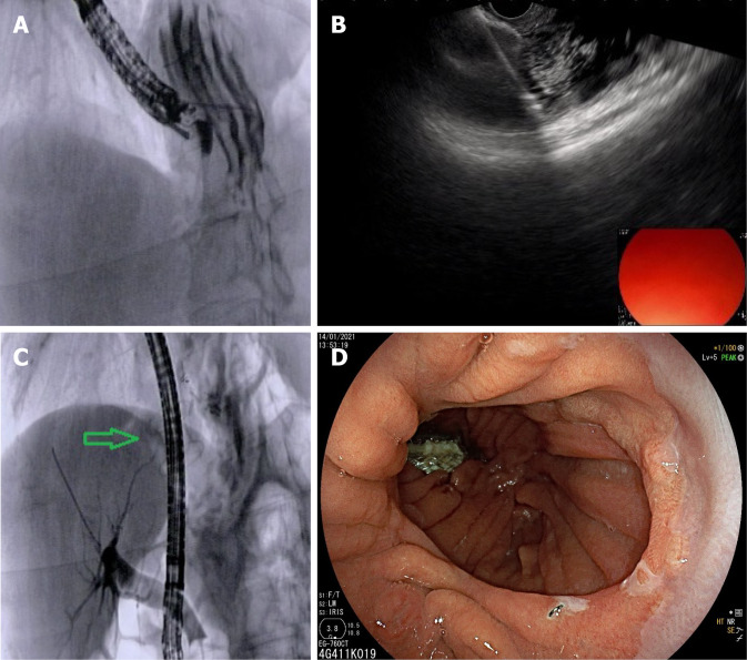 Endoscopic ultrasonography-directed transgastric endoscopic retrograde cholangiopancreatography for management of common bile duct stone in patient with previous Roux-en-Y gastric bypass for bariatric surgery. A: Endoscopic ultrasonography (EUS)-guided puncture of the excluded stomach with a 19G EUS needle with injection of contrast medium and sterile saline for gastric distension under fluoroscopic control; B: EUS guided first flange deployment of 20 mm lumen apposing metal stent (LAMS) into the gastric remnant; C: Endoscopic retrograde cholangiopancreatography for stone removal was performed after advancing the duodenoscope through the LAMS (green arrow); D: Endoscopic image confirming placement of the LAMS within the gastric pouch.