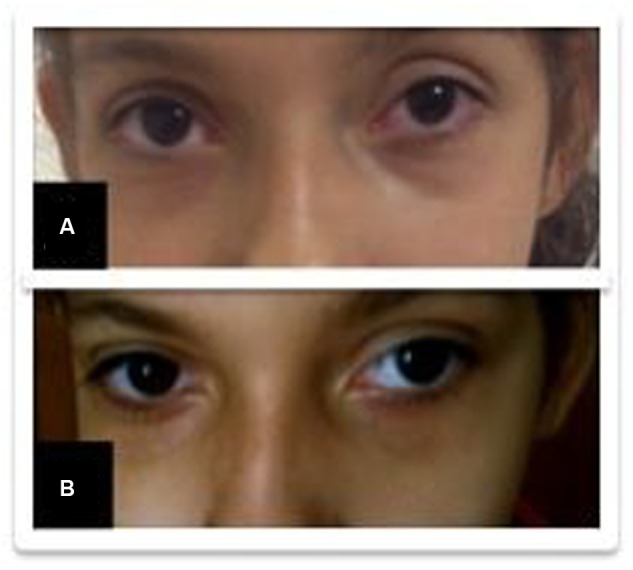 Improvement of eye redness (from A to B) after replacement of the cannabidiol (CBD)-enriched extract.