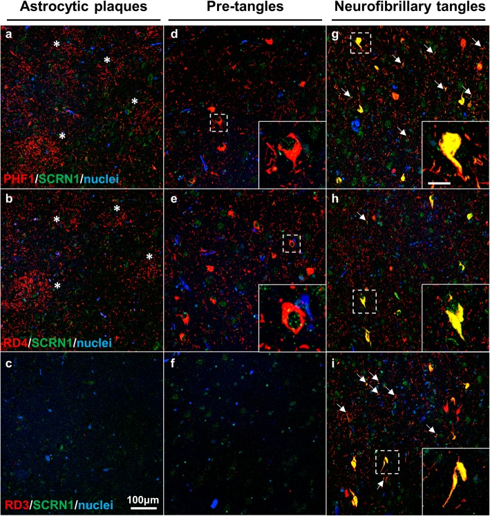 SCRN1 only colocalizes with AD-associated pathology in a CBD case with AD comorbidity. a-c Astrocytic plaques (asterix) consistent with CBD pathology contained PHF1 positive pTau, but not SCRN1 (a). RD4 (b) and RD3 (c) immunostaining confirmed 4R tau specificity. d-f RD4 positive pre-tangles (e) associated with CBD pathology showed immunoreactivity for PHF1 (d) but not SCRN1. g-i Presence of SCRN1 in lesions containing PHF1(g), RD4 (h) and RD3(i) positive pTau consistent with AD-associated NFTs pathology and dystrophic neurites (arrows). Scale bar for inserts: 25 μm