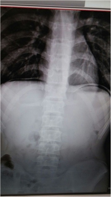 Plain abdominal radiogram: subdiaphragmatic free air