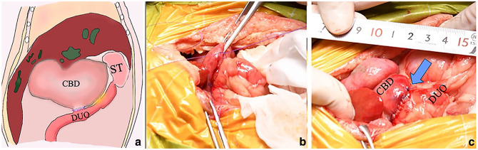 (a) Surgical procedure: schematic figure on the surgical technique. After cutting the common bile duct and duodenum (5 cm distal from the duodenal papilla), the anastomosis between the common bile duct and duodenum was performed. Surgical images: (b) retracting the common bile duct and duodenum using two stay sutures; and (c) choledochoduodenostomy using a simple side-to-side anastomosis between common bile duct and duodenum. The blue arrow indicates suturing site. Tape measure in centimetres shown for scale. CBD = common bile duct; DUO = duodenum; GB = gallbladder