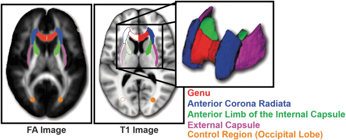 Diffusion tensor imaging regions of interest. Diffusion tensor imaging bilateral regions of interest identified using the Johns Hopkins University atlas, which included the genu of the corpus callosum (red), anterior limb of the internal capsule (green), external capsule (purple) and anterior corona radiata (blue). In addition, a bilateral control region was created at Montreal Neurological Institute coordinates (24, −75, 16) and (−22, −75, 16) in the occipital lobe (orange) and expanded to spheres of radius of 4 mm around those points.