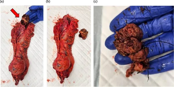 Gross pathological specimens. (a) Resected right hemicolectomy specimen showing a large calcified gallstone within the hepatic flexure (arrow). (b) The same specimen after removal of the gallstone, demonstrating marked colonic wall thickening and a 20 mm serosal defect at the site of the cholecystocolonic fistula. (c) Fragmented gallbladder measuring 50 × 30 × 20 mm, with multiple full‐thickness defects measuring 5–15 mm, consistent with fistulous communication.