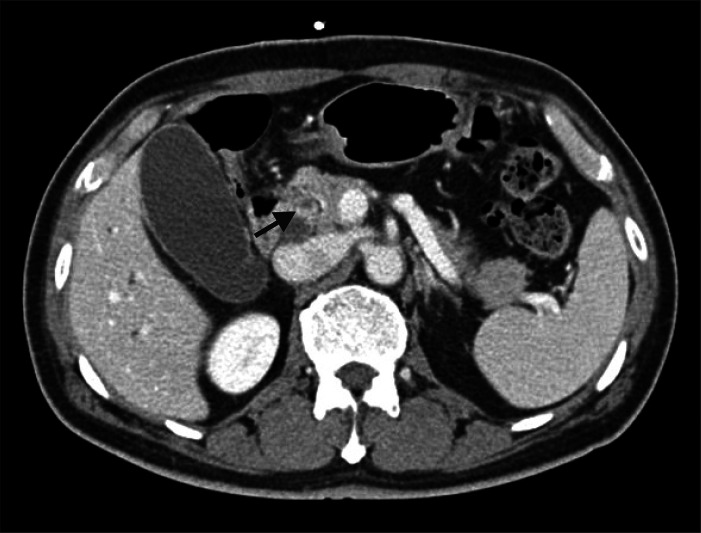 Follow-up computed tomography scan 1 month after the treatment for pyogenic abscess shows 1.5 cm enhancing portion in the intrapancreatic common bile duct (CBD) with progression of biliary dilatation suggesting distal CBD cancer (arrow).