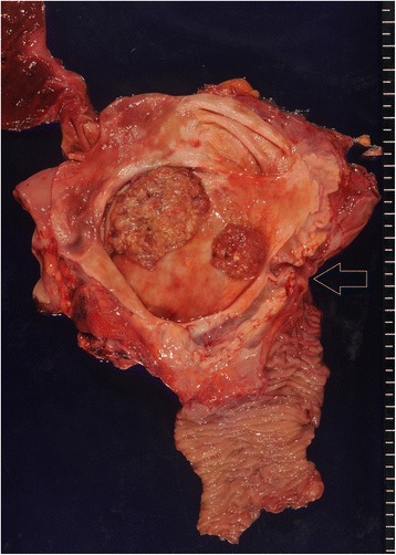 The resected specimen demonstrated tumors in the inferior and middle bile ducts. Arrow indicates the papilla of Vater