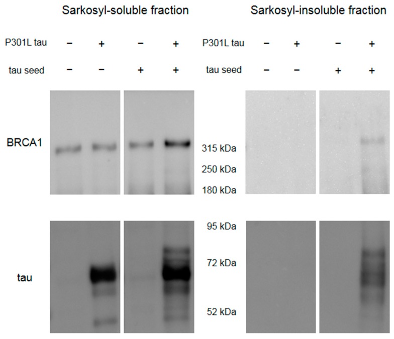 Western blot of HEK293FT cells overexpressing Venus-tagged human full-length BRCA1 with or without transfection with P301L tau and in vitro generated tau seeds. Sarkosyl-insoluble BRCA1 was observed only in the cell sample transfected with both P301L tau plasmid and tau seeds, which showed sarkosyl-insoluble tau.