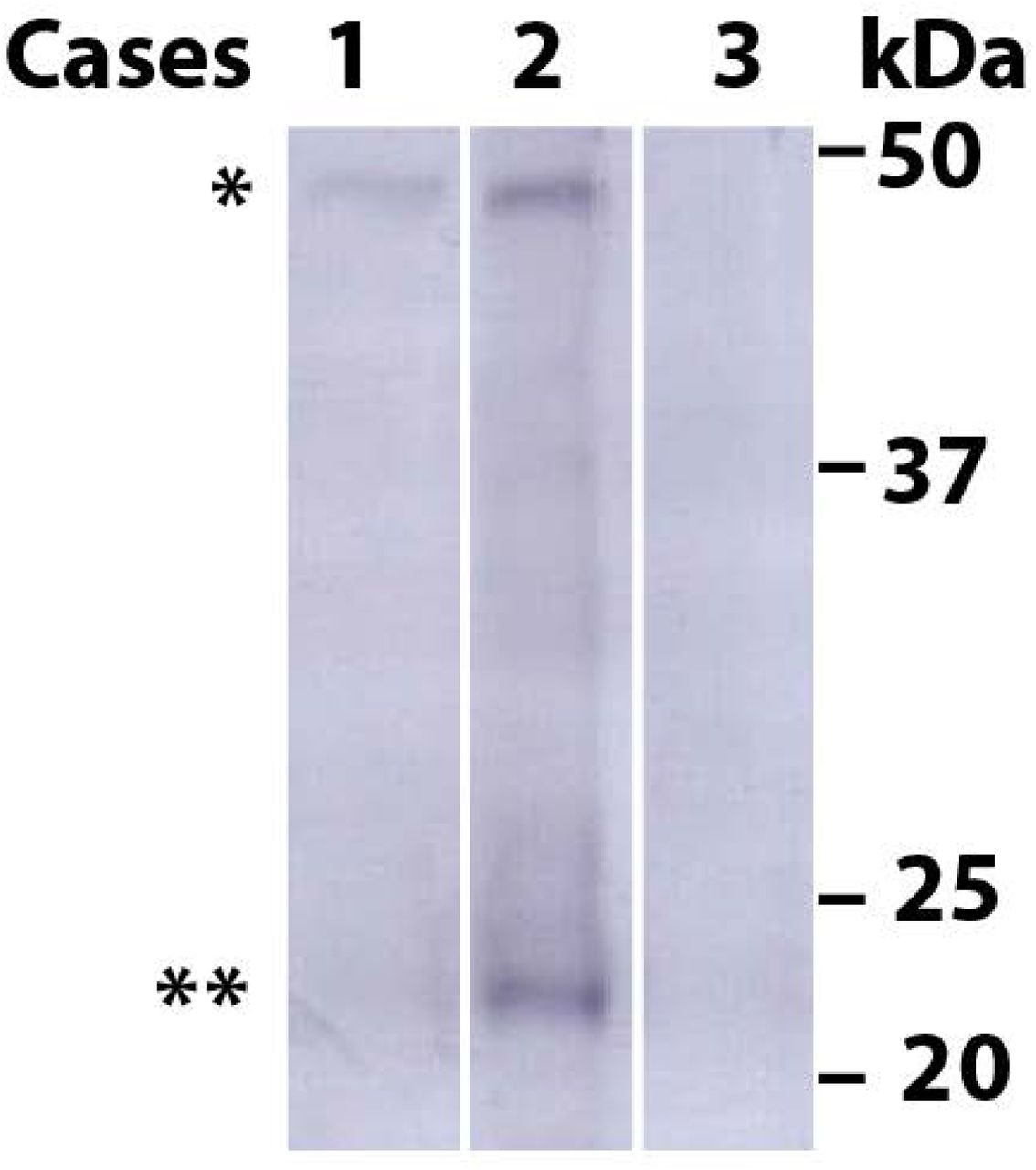 Assembled TDP-43 in frontal cortex of CBD cases 1-3.a, Immunoblots using anti-phospho-TDP-43 antibody. Sarkosyl-insoluble material was prepared as described and all the samples were applied on the same gel. The 43 kDa band (*) corresponds to full-length TDP-43 and the 18-26 kDa bands (**) to C-terminal fragments.