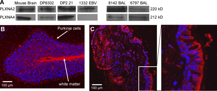 Distribution of plexin A proteins in antigen-presenting cells, BAL fluid, and lung tissue derived from CBD patients. (A) Western blot analysis of cell extracts from the mouse fibroblast cell lines (DP8302 and DP2.21) and EBV-transformed B cells from CBD patient 1332 and BAL fluid from two representative CBD patients is shown. Anti-plexin antibodies cross-react to mouse and human plexin A2 and A4. BAL fluid samples were concentrated 300-fold and resolved on a 7.5% polyacrylamide gel. Results are representative of a minimum of three independent experiments for cell extracts and BAL fluids. (B and C) Immunofluorescence staining of plexin A2 (red) and cell nuclei (blue) in mouse cerebellum (B) and transbronchial lung biopsy tissue from a CBD patient (C) is shown. An enlarged view of the area within the white box in C showing plexin A2 expression in bronchial epithelial cells is shown in the right panel. Results are representative of the three transbronchial lung biopsy specimens analyzed.