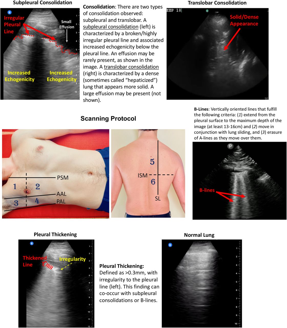 Scanning Protocol and Lung Ultrasound Findings in COVID-19 Patients. This study utilized a 12-zone protocol.4 On each hemithorax, there are 6 zones. The exam begins on the patient’s right side. Zones 1-2 (anterior zones) are between the parasternal margin (PSM) and the anterior axillary line (AAL) and are best obtained in the mid-clavicular line. Zones 3-4 (lateral zones) are between the anterior axillary line (AAL) and posterior axillary line (PAL) and are best obtained in the mid-axillary line. The nipple line serves as a bisecting area between these zones. Zones 5-6 (posterior zones) are medial to the scapular line (SL) and are bisected by the inferior scapular margin (ISM). The zone areas are repeated on the contralateral hemithorax (starting with zone 7). This figure contains an overview of the observed ultrasound findings based on previously described terminology.4,6,7