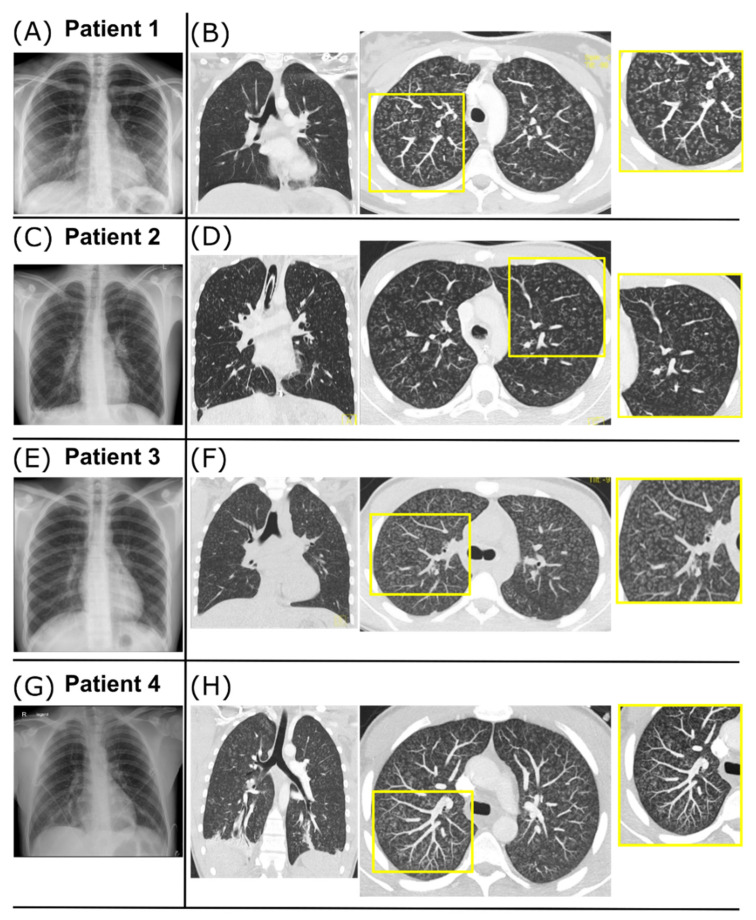Radiographic findings. (A,B) Radiographic findings for Patient 1. Chest X-ray on day 2 showing signs of peribronchial cuffing (A). Coronal CT image on day 8 shows diffuse and homogenous distribution of centrilobular micronodules and tree-in-bud pattern through the whole lung (B, left). Axial maximal intensity projection (MIP, 5 mm thickness) of the CT scan improves the detection and distribution of the disease pattern (B, right). In the magnified view, the tree-in-bud pattern is mostly explained by peribronchial thickening. (C,D) Radiographic findings for Patient 2. Chest X-ray on day 1 shows slight enlargement of the hilar lymph nodes, increased peribronchial and interstitial markings, small opacification in the right basal area, and small bilateral pleural effusions (F). Coronal CT image on day 4 (G, left) and axial MIP magnification (G, right) show diffuse and homogenous tree-in-bud pattern, mostly due to endobronchial pathology (G). (E,F) Radiographic findings for Patient 3. Chest X-ray on day 6 shows diffuse bilateral peribronchial markings with basal dominance and small pleural effusions suspicious for atypical pneumonia (E). Coronal CT image on day 6 (F, left) and axial MIP magnification (F, right) show tree-in-bud pattern due to peribronchial thickening with diffuse and homogenous distribution through the whole lung. (G,H) Radiographic findings for Patient 4 (provided by the Department of Radiology, Medical University Innsbruck, Austria). Chest X-ray on day 1 shows bilateral widespread nodular opacities (G). Coronal CT image on day 2 (H, left) and axial MIP magnification (H, right) show diffuse and homogenous tree-in-bud pattern through the whole lung caused by peribronchial thickening (H).