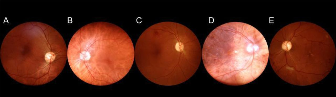 Diabetic Retinopathy images from mBRSET. A: Normal retina, B: Mild non-proliferative DR, C: Moderate non-proliferative DR, D: Severe non-proliferative DR, E: Proliferative DR