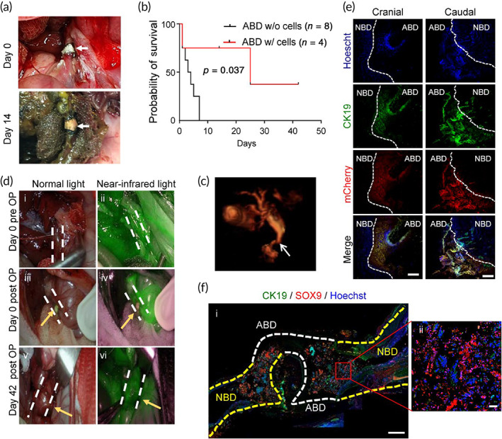 In vivo transplantation of artificial bile duct (ABD) loaded with hCdH‐Chols. (a) Photographs of end‐to‐end anastomosis between artificial bile duct (ABD) graft and native common bile duct (NBD) taken immediately after and 2 weeks after surgery. White arrow, ABD graft. (b) Kaplan–Meier survival analysis. Rabbits receiving cell‐laden ABD implants were monitored for 42 days. (c) Magnetic resonance imaging (MRI) imagining of hepatobiliary tree performed at 14 days postimplantation. White arrow, anastomosis site. (d) Gross observation of abdominal cavity from duodenum site and fluorescent images under near‐infrared light taken after indocyanine green (ICG) injection into auricular vein in normal healthy rabbit (i and ii), immediately after operation (iii and iv) and at 42 days after operation (OP) (v and vi). White dash lines define rabbit bile duct. (e) Double immunofluorescence staining of bile duct anastomosis with CK19 and mCherry antibodies. Cranial means gallbladder‐common bile duct connection and caudal means common bile duct‐duodenum connection. White dash lines show interface between NBD and ABD. Scale bar: 250 μm. White dash lines show interface between NBD and ABD. Scale bar: 250 μm. (f) Double fluorescence staining with CK19 and SOX9 antibodies of the reconstructed bile duct sectioned through duodenum and liver side. Yellow and white dash lines define NBD and ABD, respectively. Scale bars: 1000 μm (i), 50 μm (ii)
