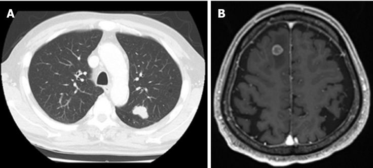 Magnetic resonance imaging of a metastatic lung tumor in the left upper lobe (A) and suspected metastatic brain tumor on the right frontal lobe (B).