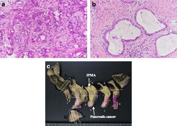 Histological examination. a Moderately differentiated ductal adenocarcinoma of the pancreas. b Well-differentiated tubular adenocarcinoma of the gallbladder. c There was no continuity in histopathological examination between pancreatic cancer and IPMA