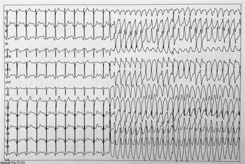 Patient 1: Exercise test, early recovery phase. Sinus rhythm followed by polymorphic ventricular tachycardia starting with ventricular premature beat.
