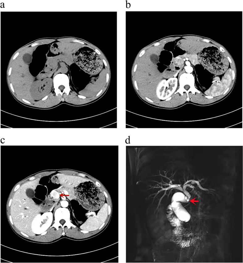 a Axial pre-contrast CT image. b axial post-contrast CT image in arterial phase. c Axial post-contrast CT image in portal venous image in delayed phase shows a heterogeneously enhancing mass at common bile duct (CBD) [red arrow in (c)]. d MRI image shows diffuse dilatation of the intrahepatic biliary radicles and proximal common bile duct (CBD) with narrowing noted at the middle of the CBD