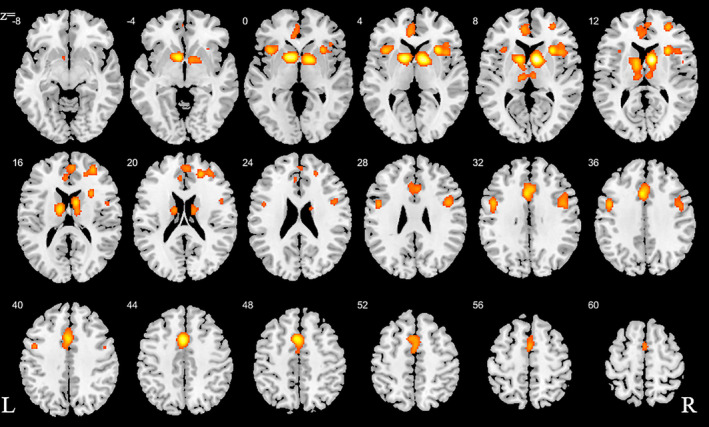 ALE for combined studies. All slices in transverse view with ascending slice number. Displayed at FWE < 0.05