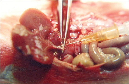 OK-432 being injected into the common bile duct