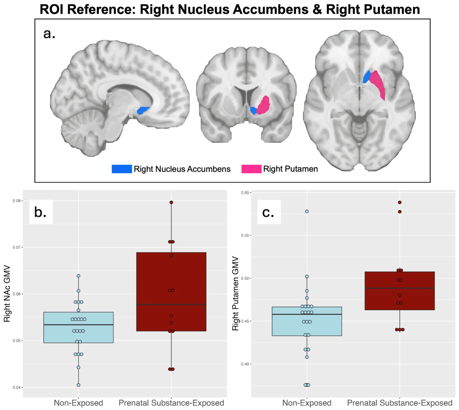 (a) Nucleus accumbens (NAc) (blue) and right putamen (pink) shown on a standard template to illustrate anatomical location. Box plots of (b) right NAc and (c) right putamen gray-matter volume (GMV) for non-exposed (n = 22) and prenatal substance-exposed (n = 12) groups. GMV values are unadjusted (raw).