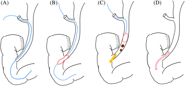 Schema of one‐stage laparoscopic transcystic papillary balloon dilation and laparoscopic cholecystectomy. A, The guidewire was cannulated into the duodenum beyond the papilla of Vater through the common bile duct. B, Balloon dilation of the papilla of Vater. C, The stones were extruded with the balloon, and the common bile duct was cleaned. D, Placement of a pigtail‐shaped drainage catheter