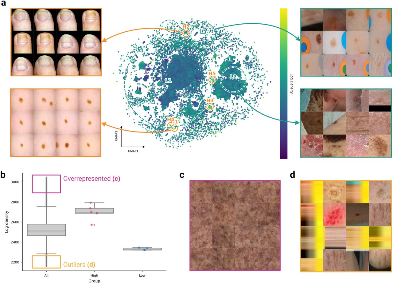 Embedding space density as an automated quality assurance mechanism.a, UMAP projection of the SkinMap embedding space overlaid with a Gaussian mixture model density map. Dashed circles indicate regions of hypersaturation (high density, H1−H5) and sparsity (low density, L1−L4). b, Boxplot distribution of log-density scores distinguishing core clusters from peripheral outliers. c, Representative samples from high-density peaks, revealing visual homogeneity and redundancy in common lesions. d, Representative samples from low-density regions, effectively isolating data quality failures, including non-clinical images, reconstruction artifacts, and heavy occlusions.