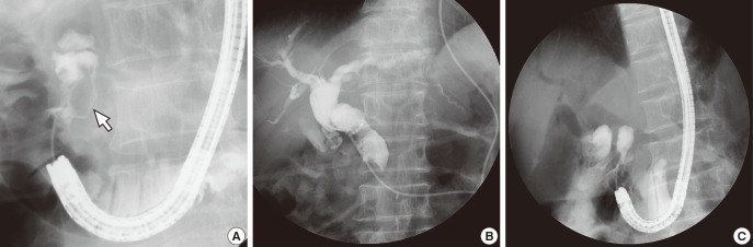 Fluoroscopic images. When dye is injected into the PAD, an ovoid shaped filling defect (white arrow) can be seen (A). Endoscopic nasobiliary drainage tubogram obtained after decompression of the PAD demonstrates resolved extrinsic compression (B). After completion of enterolith removal, filling defect is no longer seen within the PAD (C).