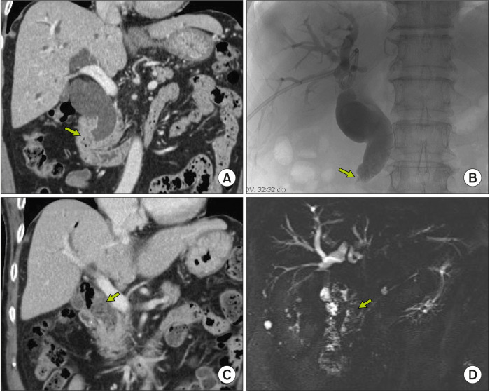 The preoperative finding of Case No. 2. Computed tomo-graphy (CT) and direct cholan-giography taken 10 years before surgery (A, B) show marked dilatation of the common bile duct with an obstructing mass at the sphincter (arrows), which was later proven to be a benign stricture. CT scan and magnetic resonance cholangiography taken 1 month before surgery (C, D) show that the common bile duct is filled with stones and sludges (arrows).
