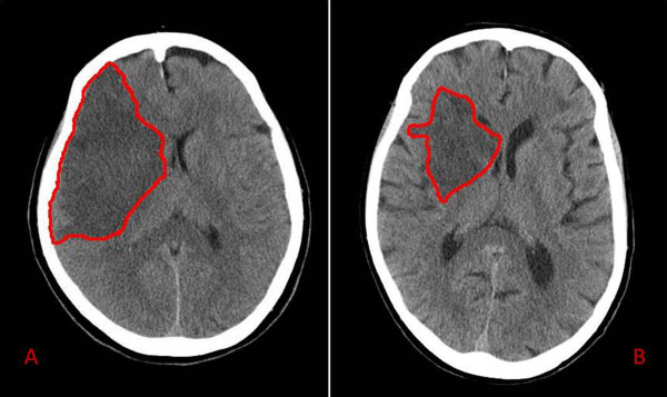 Follow-up brain CT scans of two stroke patients. Two examples of CT scans of two stroke patients at 48 hours since admission. The red outline circumscribes the ischemic area. The patient in panel A had a total occlusion of right middle cerebral artery, presenting with left hemiparesis and hemianopia (Female; Age = 80 yrs.; T0 AEA = 7.31 pmol/lipid mg; T0 NIHSS = 17; T0 aFMS score = 12). The patient in panel B was admitted for a left hemiparesis due to a partial occlusion in right middle cerebral artery territory (Female, Age = 82 yrs.; T0 AEA = 3.93 pmol/lipid mg; T0 NIHSS = 10; T0 aFMS score = 18).