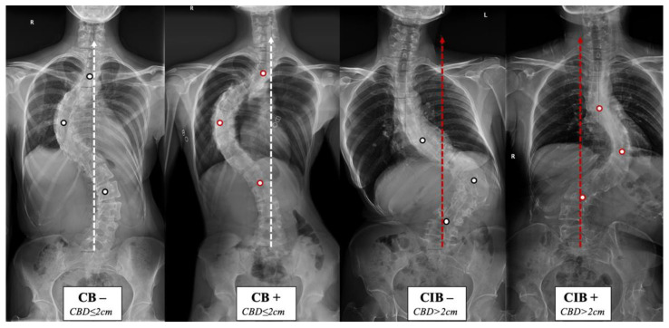 Coronal balance classification of adult idiopathic scoliosis according to the standing anterior-posterior whole spine radiograph. The apical vertebras distribution modifier (+/−) is introduced to supplement the previous classification based on the coronal balance distance (CBD). CB is diagnosed if CBD ≤ 2 cm, and CIB is diagnosed if CBD > 2 cm. The apical vertebra modifier is defined as negative (−) when CoAVs are on either side of the CSVL. The apical vertebra modifier is defined as positive (+) when CoAVs are on the same side of the CSVL. The white dots represent CoAVs, and the dotted arrows represent the CSVL.