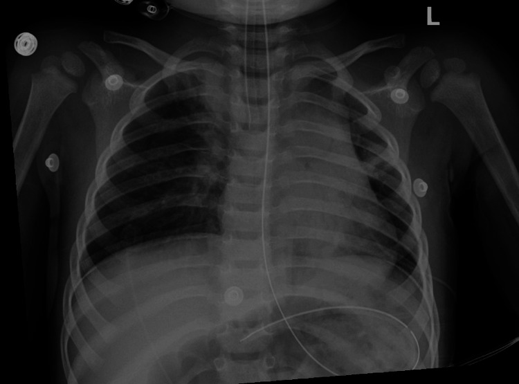 Chest radiograph obtained after intubation demonstrating no acute cardiopulmonary abnormalities.
