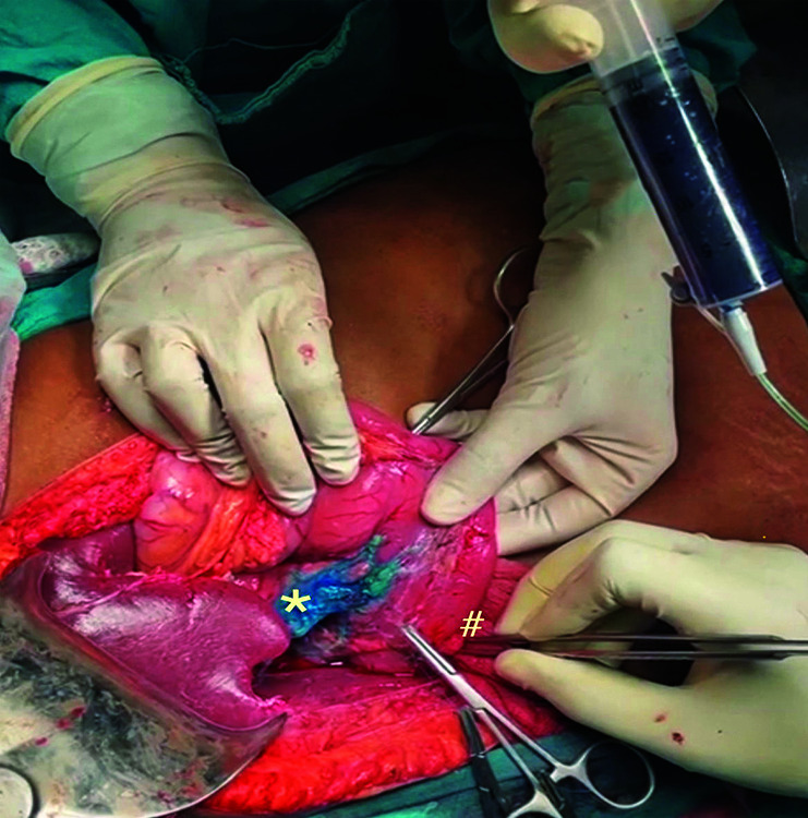 Dye was injected through the IFT in the ampulla of duodenum to demonstrate the leak of dye from the posterosuperior part of pancreas; the left lower quadrant of the image showed part of the liver; (big arrow = dye filled syringe connected to the IFT; # = cannulated IFT in the ampulla was held in position with forceps; * = leak of dye from the retracted distal stump of CBD in the superoposterior part of pancreas)