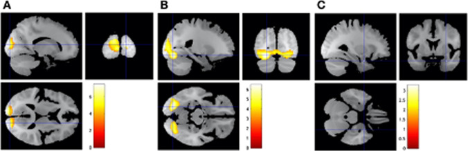 A Happy faces, relative to neutral faces, increased BOLD responses in the right calcarine gyrus. B Fearful faces, relative to neutral faces, increased BOLD responses in the left lingual gyrus. C There was a non-significant effect within the a priori amygdala region-of-interest. Statistical maps are overlaid on the sample mean structural image. A voxel-based threshold of ɑ = .001 (uncorrected) was used to form the beta clusters, after which a cluster-level threshold of ɑ = .05 (FWE-corrected) was applied. Coloured bars indicate t-values (n = 24)