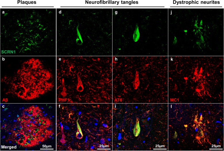 Secernin-1 accumulation in NFTs and dystrophic neurites in AD. Sections were immunostained with α-SCRN1 and 4G8/6E10 (aβ, a-c) or the pTau markers PHF1 (d-f), AT8 (g-i) and MC1 (j-l)
