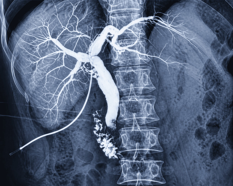 T-tube cholangiogram demonstrating the intrahepatic and extrahepatic biliary ducts, with contrast flow into the duodenum.