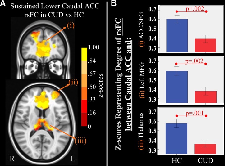 Main effect of group of caudal anterior cingulate cortex (ACC) resting-state functional connectivity (rsFC) identified by a 2 × 2 mixed-model (group × time) analysis controlling for alcohol and nicotine. (A) TOP LEFT: Coronal Montreal Neurological Institute (MNI) brain slice (y = 44) illustrating a cluster that showed a significant main effect of group in rsFC between the caudal ACC seed and (i) a cluster comprised of dorsal ACC, rostral ACC, and right superior frontal gyrus (ACC/SFG) (Brodmann areas 9, 10, and 32; 6,877 voxels). BOTTOM LEFT: Axial slice (z = 12) of MNI brain illustrating clusters that showed a significant main effect of group in rsFC between the caudal ACC seed and (ii) left (L) medial frontal gyrus (MFG) (Brodmann area 10; 684 voxels) and (iii) bilateral medial dorsal nucleus of the thalamus (1,940 voxels). (B) RIGHT: Bar graphs representing mean (error bars: +/− 1 standard error) illustrating significant main effects characterized by lower rsFC between caudal ACC and (i) ACC/SFG (F = 11.260, p = 0.002), (ii) left MFG (F = 10.630, p = 0.002, and (iii) medial dorsal nucleus of the thalamus (F = 11.888, p = 0.001) in individuals with cannabis use disorder (CUD) than healthy controls (HC) across time.