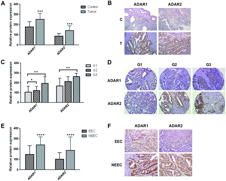 ADAR1 and ADAR2 proteins are overexpressed in EC. Panel A. ADAR1 and ADAR2 expression in EC tumors (T) compared to the paired control (C) tissues. Relative protein expression of each enzyme is plotted in the bar graphs. Panel B. Example of ADAR1 and ADAR2 staining levels in a matched EC tissue with the corresponding paired control. Panel C. ADAR1 and ADAR2 expression in EC tissues significantly correlate with the tumor grade. Panel D. Example of ADAR1 and ADAR2 staining levels in a set of 3 different EC tumor grades slides (grade 1, 2 and 3). Panel E. ADAR1 and ADAR2 levels are significantly increased in NEEC compared to EEC tumors. Panel F. Example of ADARs staining in EEC and NEEC tumors.