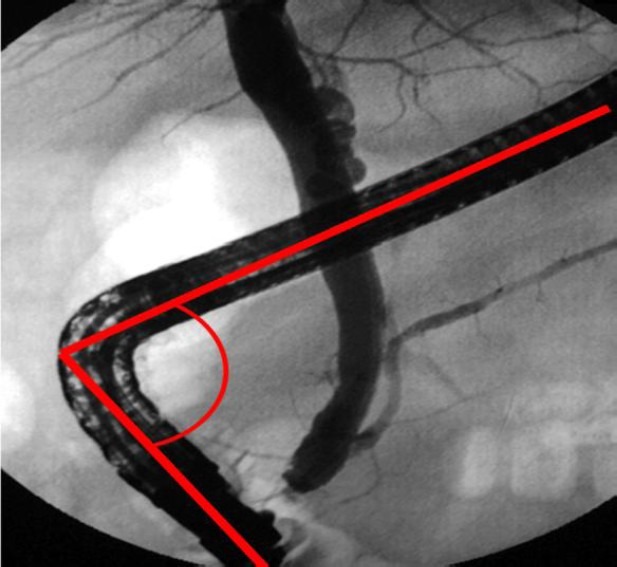 “Typical position of the duodenoscope” was defined by the red angle.