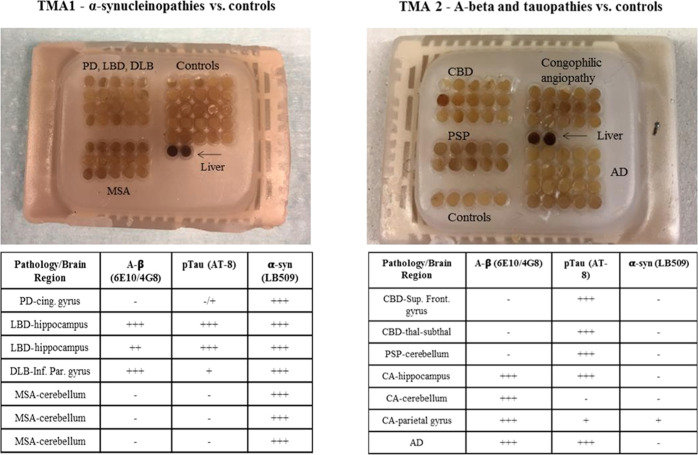 Tissue microarrays 1 and 2, containing the cases previously described; in the table is reported the amount of Aβ, tau, and α-syn deposits for each of the samples. The score + to +++ refers to a qualitative assessment of the amount of pathological inclusions.