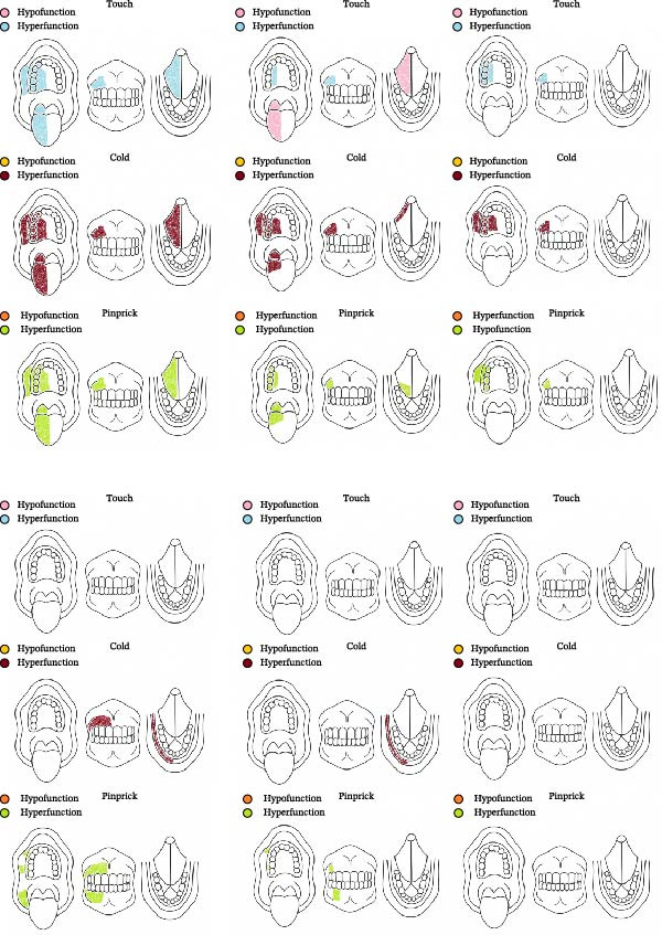 Intraoral Qualitative Sensory Testing (QualST) heatmaps depicting sensory responses across three modalities—mechanical allodynia, cold hyperalgesia, and pinprick hyperfunction—for Case 1 (upper panels) and Case 2 (lower panels). Assessments were performed at baseline (week 0), week 4, and week 8 of cannabinoid treatment.