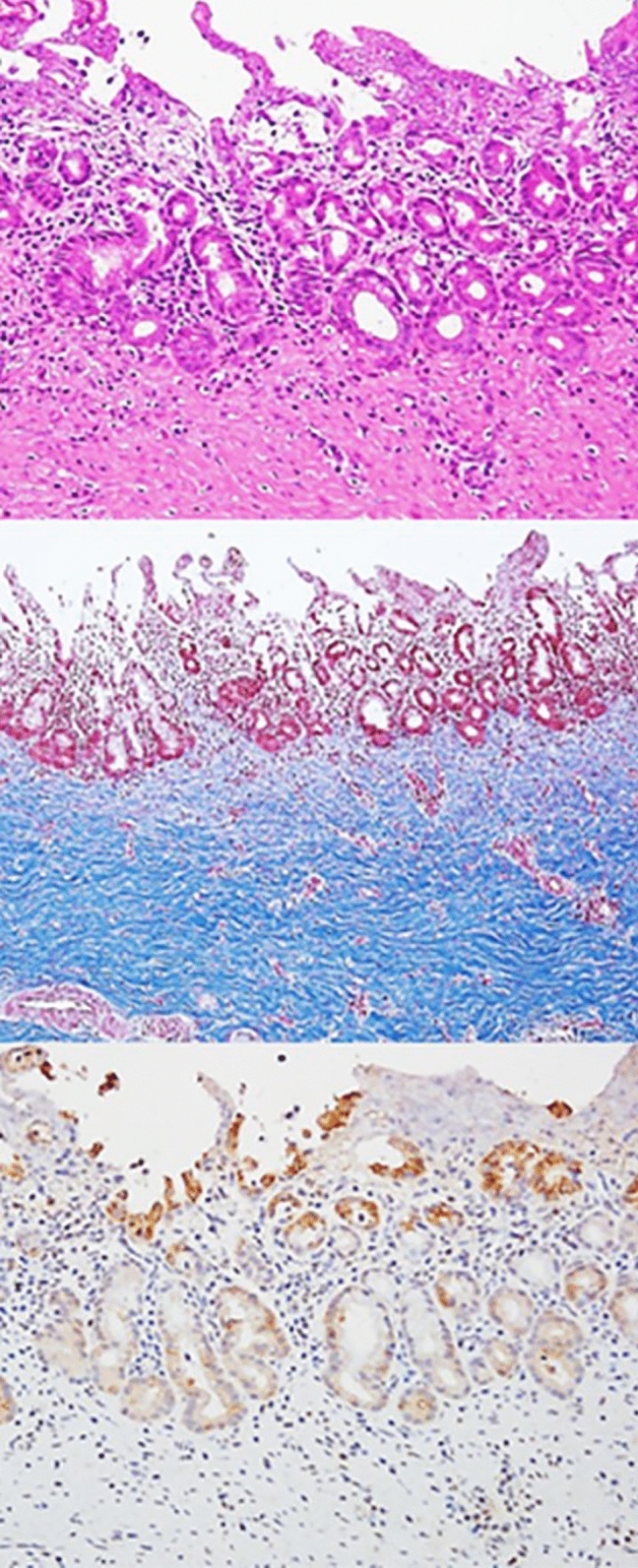 Microscopic images of plastic stented bile ducts from the swine animal model. H–E, M-T staining and CK 19 immunohistochemistry (from the top); H–E hematoxylin eosin, M-T Masson trichrome, CK 19 cytokeratin 19.