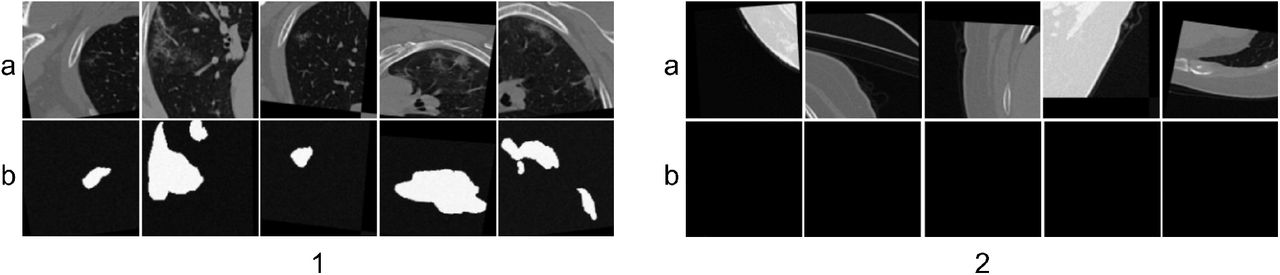 The (a) extracted patches, and (b) corresponding annotation (post-run-time augmentation), for sample slices which are 1: infected, and 2: non-infected